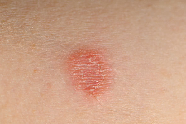 ringworm on skin